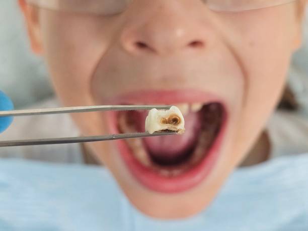 Emergency Gum Pain Relief in LA